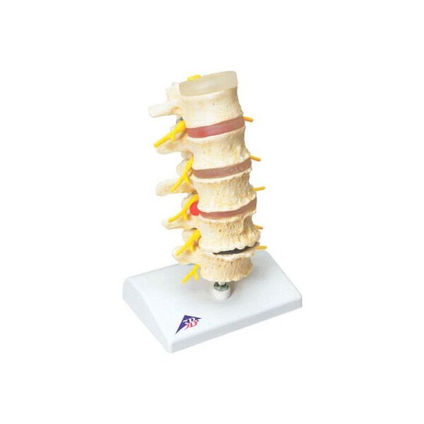 3B Anatomical Model - Vertebrae Degeneration, Stages of Prolapsed Disc